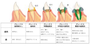 歯周病のグレード